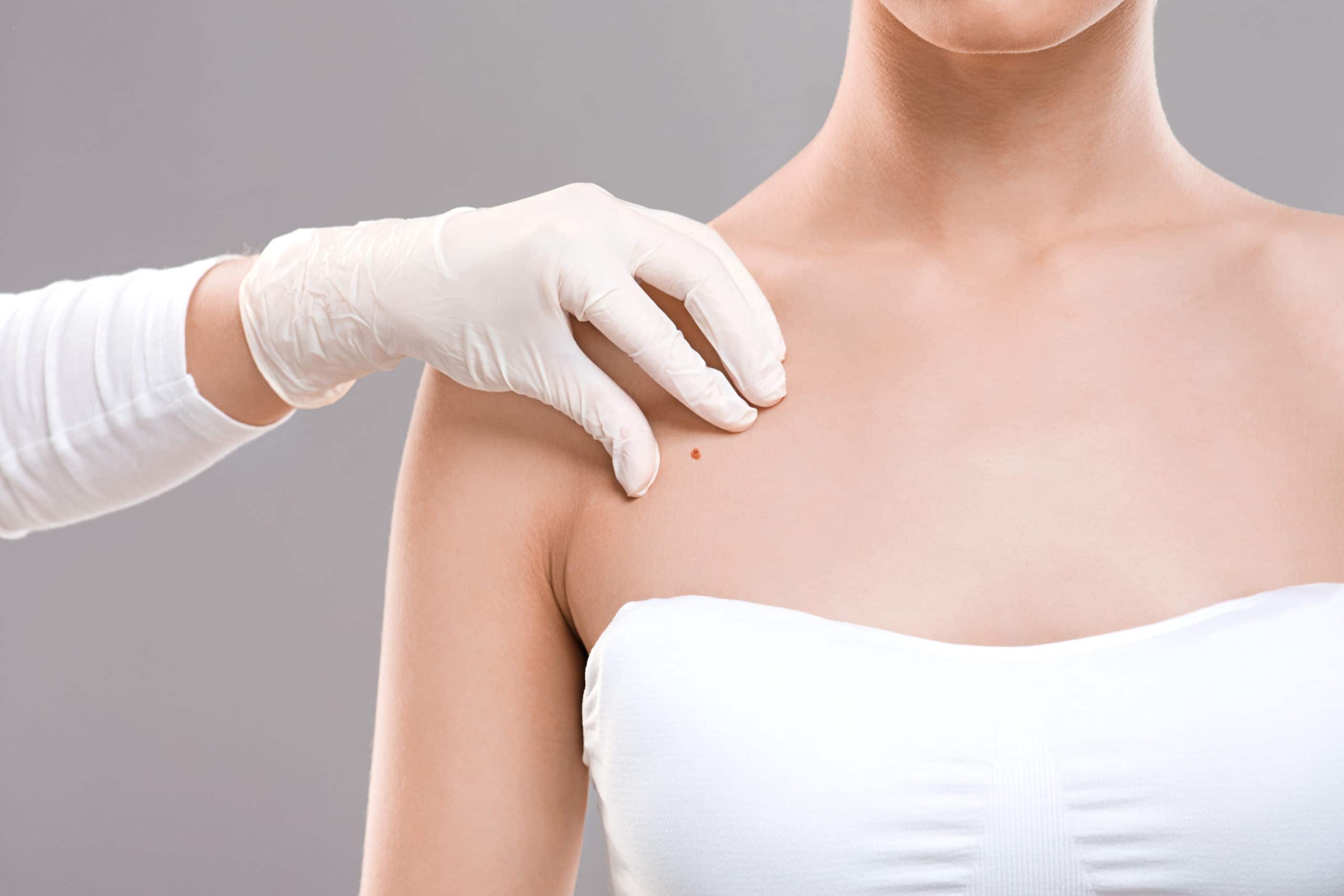 Dermatologist examining birthmark on woman body,