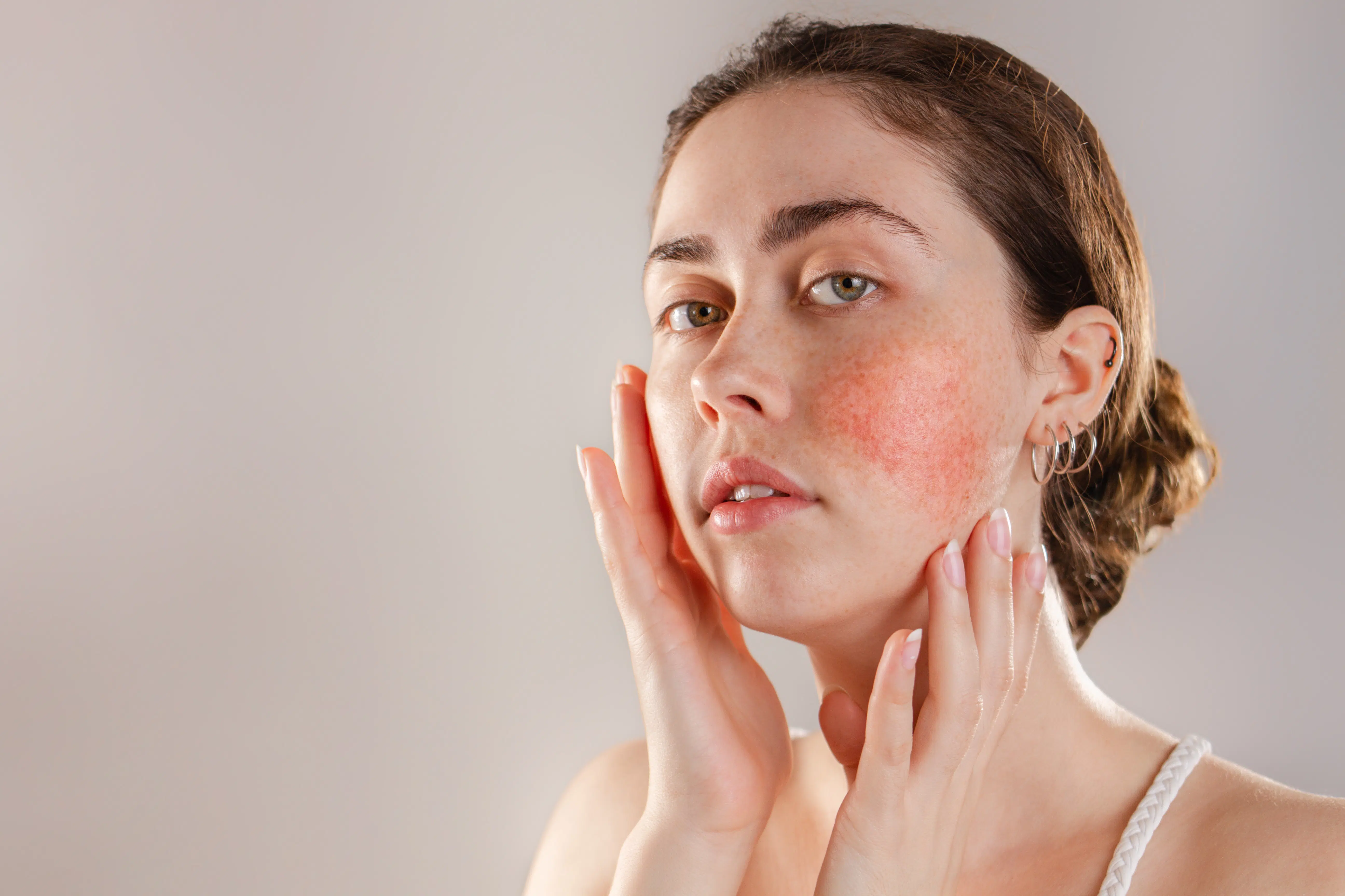 Medicine and cosmetology. Portrait of a young beautiful brunette woman with rosacea on her cheeks. Copy space